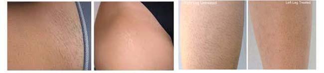 Saprano Permanent Hair Removal Equipment All Skin Colors Suitable No Harm